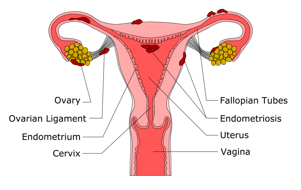 Endometriosis and Pregnancy best treatment center fertility